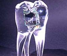Image - Wireless receiver within a tooth - http://www.wired.com/news/images/thumbs/digitaltooth_t.jpg